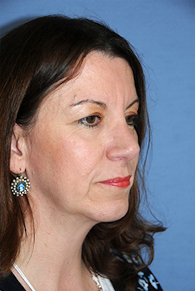 Rhinoplasty Before & After Gallery - Patient 346211 - Image 4