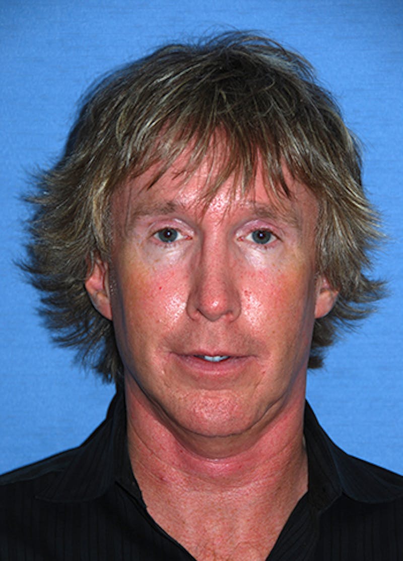 Jaw Implants Before & After Gallery - Patient 384944 - Image 1