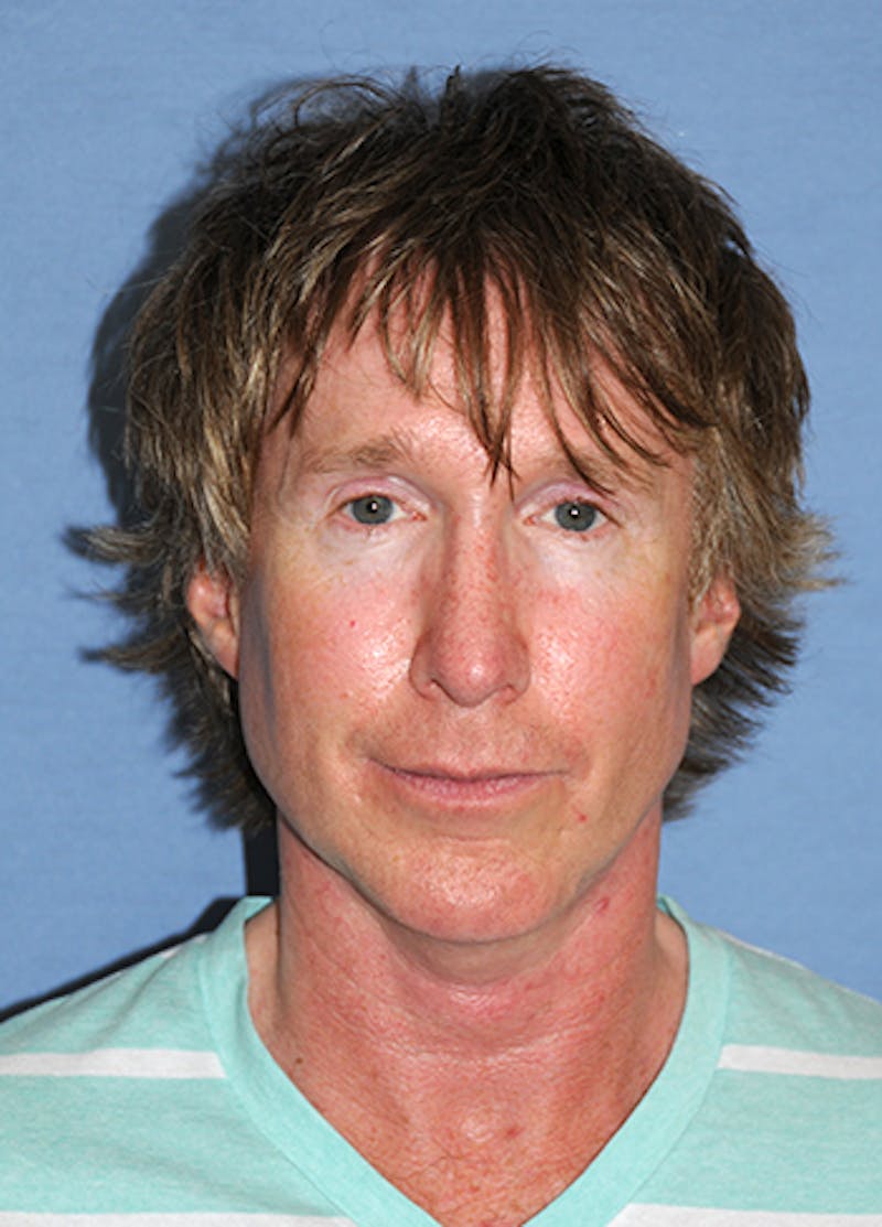 Jaw Implants Before & After Gallery - Patient 384944 - Image 2