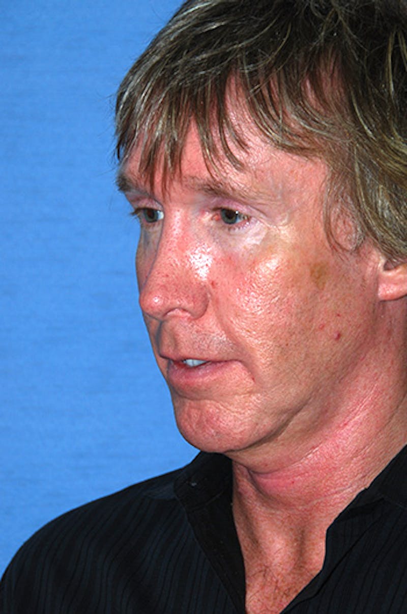Jaw Implants Before & After Gallery - Patient 384944 - Image 3