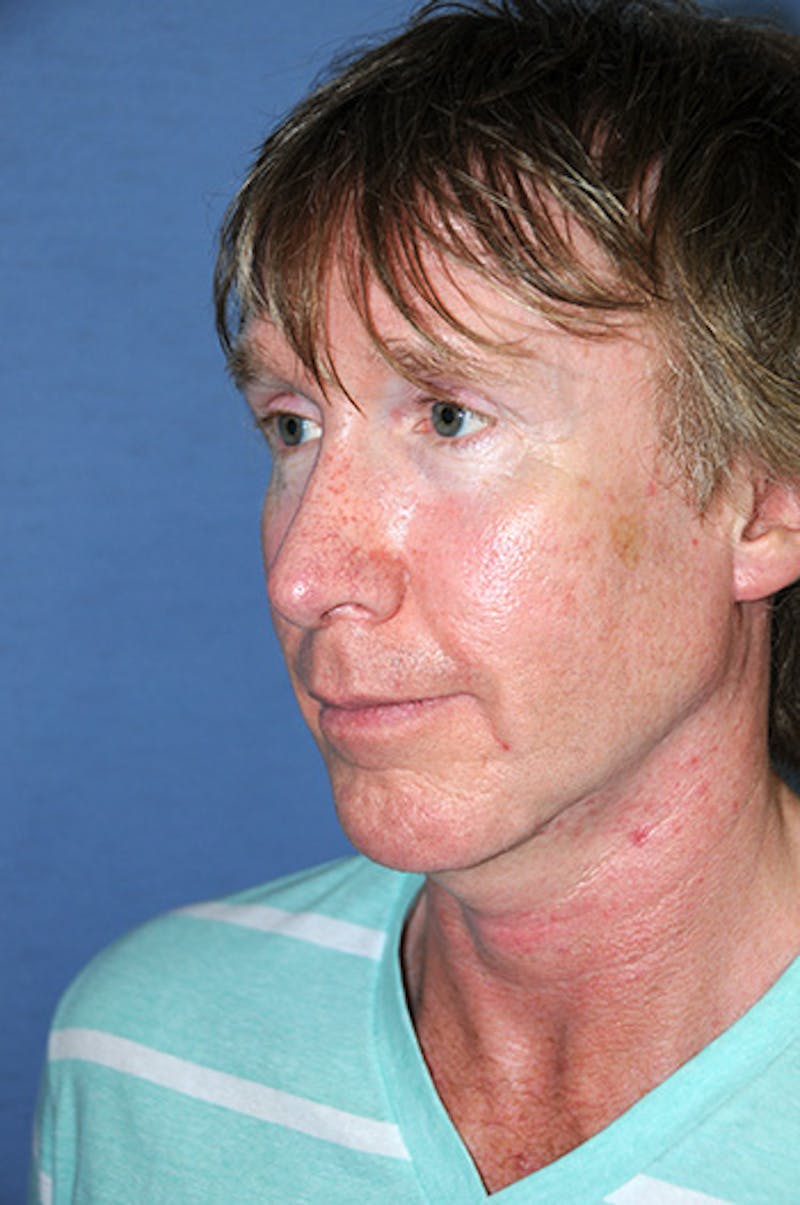 Jaw Implants Before & After Gallery - Patient 384944 - Image 4