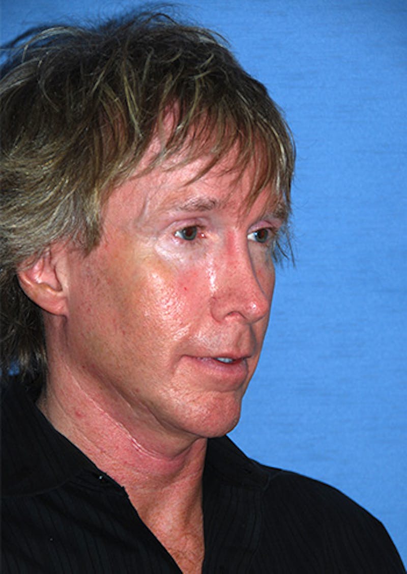 Jaw Implants Before & After Gallery - Patient 384944 - Image 5