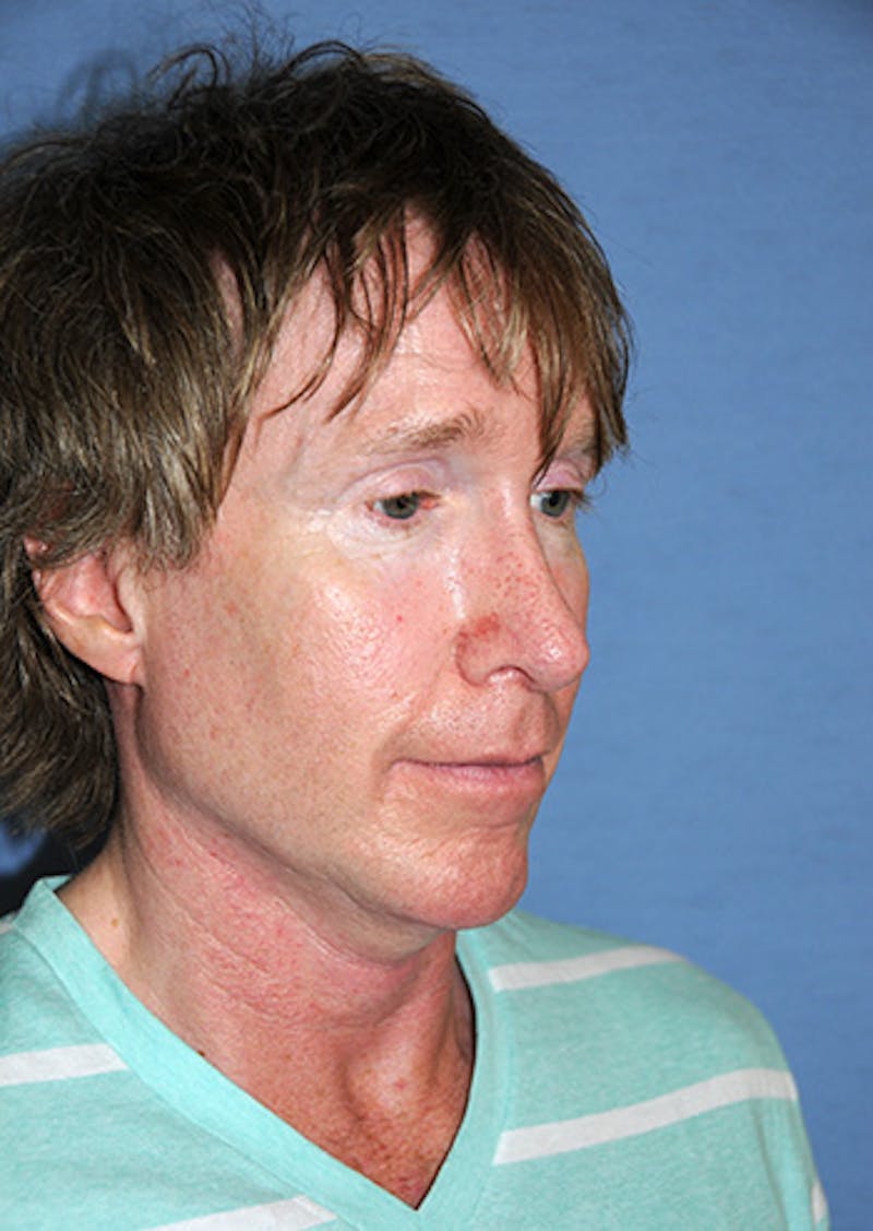 Jaw Implants Before & After Gallery - Patient 384944 - Image 6