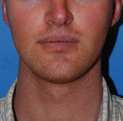 Facial Implants Before & After Gallery - Patient 238369 - Image 1