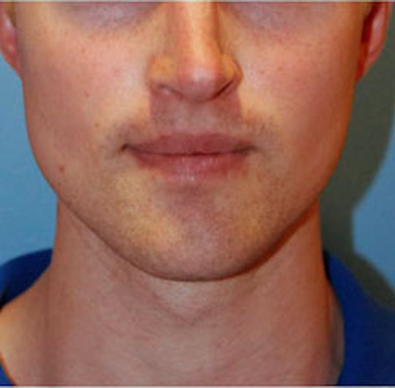 Facial Implants Before & After Gallery - Patient 238369 - Image 2