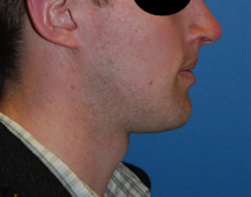 Facial Implants Before & After Gallery - Patient 238369 - Image 3