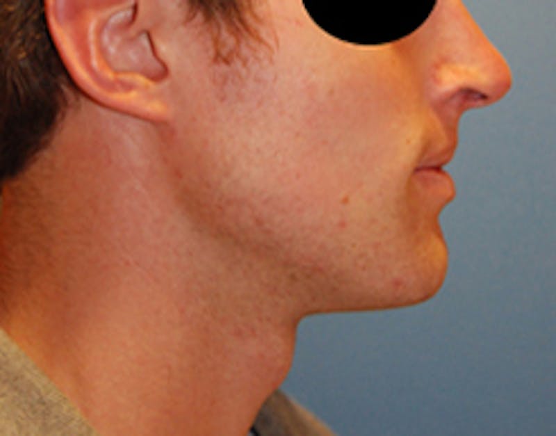 Facial Implants Before & After Gallery - Patient 238369 - Image 4