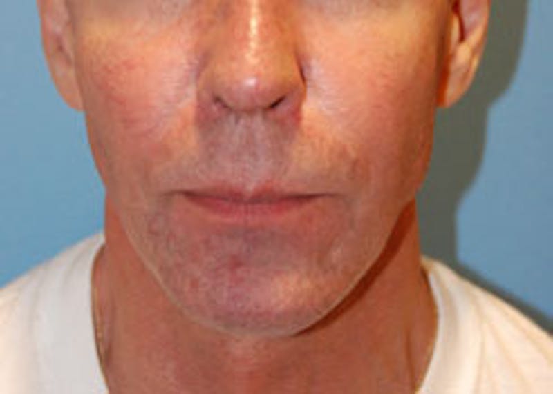 Facial Implants Before & After Gallery - Patient 467453 - Image 1