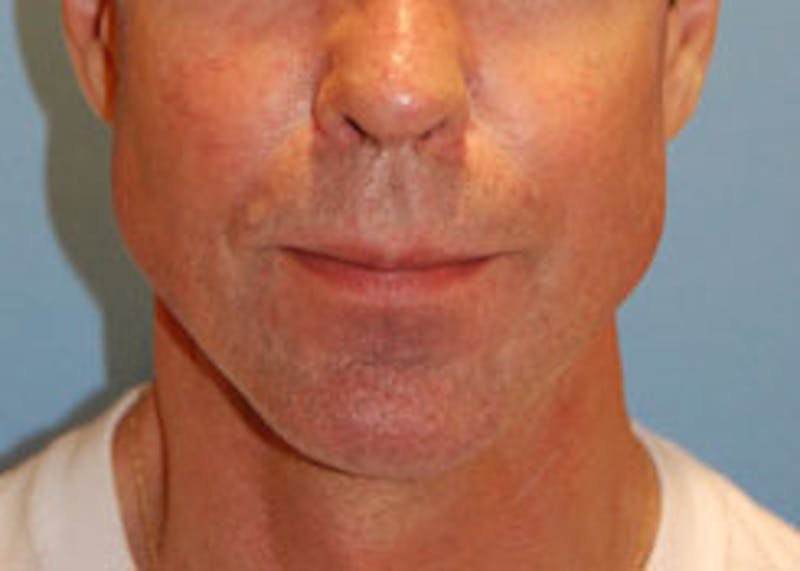 Facial Implants Before & After Gallery - Patient 467453 - Image 2
