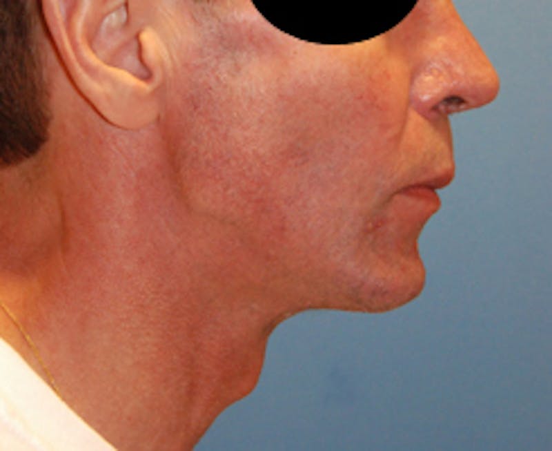Facial Implants Before & After Gallery - Patient 467453 - Image 3