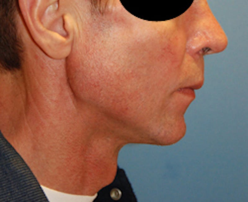 Facial Implants Before & After Gallery - Patient 467453 - Image 4