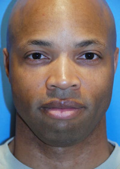 Facial Implants Before & After Gallery - Patient 189458 - Image 1