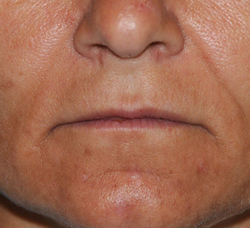 Fat Transfer Before & After Gallery - Patient 322820 - Image 1