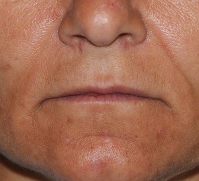 Lip Augmentation Before & After Gallery - Patient 208220 - Image 1