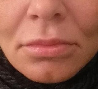 Lip Augmentation Before & After Gallery - Patient 208220 - Image 2