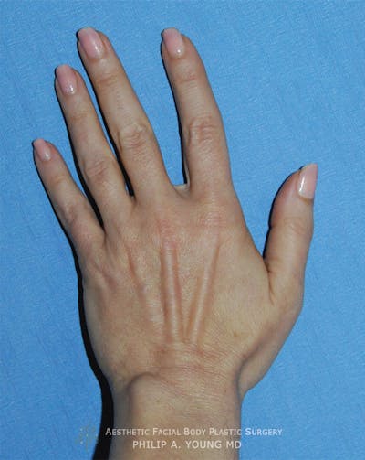 Fat Transfer Before & After Gallery - Patient 171945 - Image 1