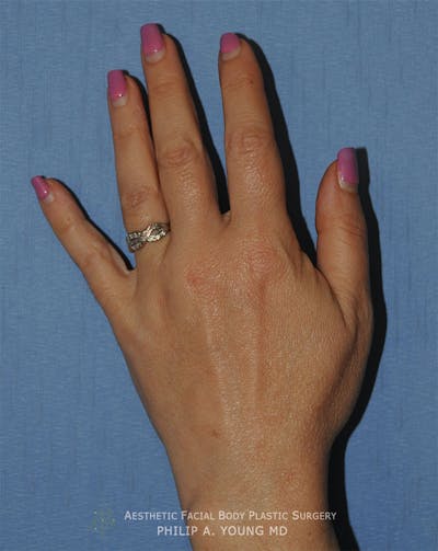 Fat Transfer Before & After Gallery - Patient 171945 - Image 2
