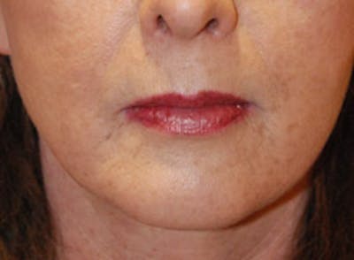 Lip Augmentation Before & After Gallery - Patient 354744 - Image 1