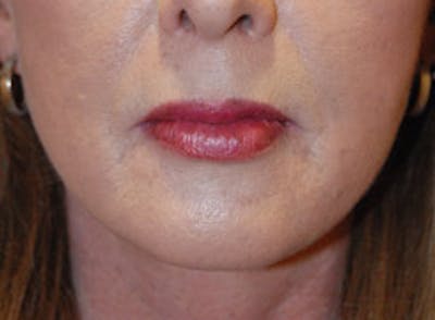 Lip Augmentation Before & After Gallery - Patient 354744 - Image 2