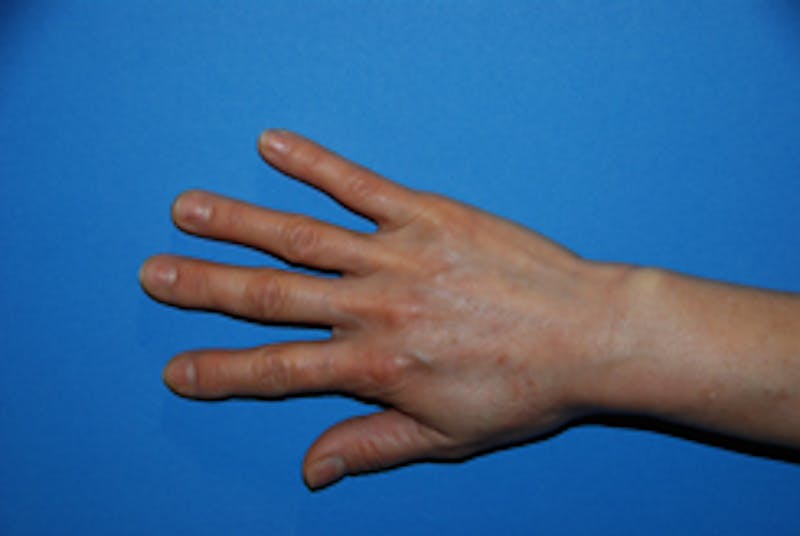 Fat Transfer Before & After Gallery - Patient 405357 - Image 1