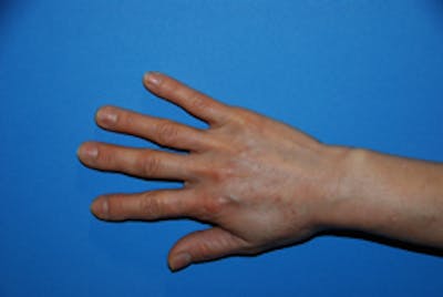 Fat Transfer Before & After Gallery - Patient 405357 - Image 1