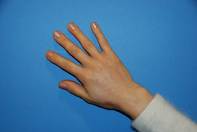 Fat Transfer Before & After Gallery - Patient 405357 - Image 2