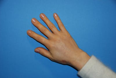 Fat Transfer Before & After Gallery - Patient 405357 - Image 2
