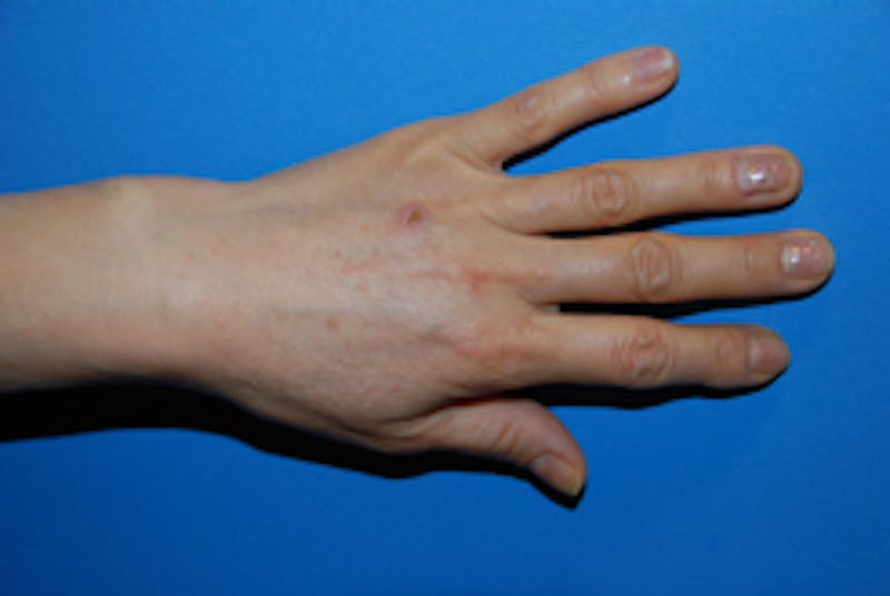 Fat Transfer Before & After Gallery - Patient 405357 - Image 3