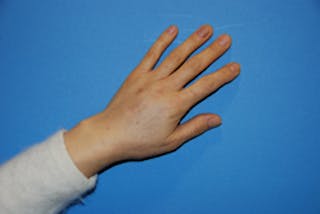 Fat Transfer Before & After Gallery - Patient 405357 - Image 4