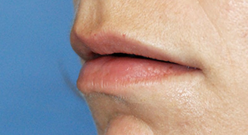 Lip Augmentation Before & After Gallery - Patient 205200 - Image 3
