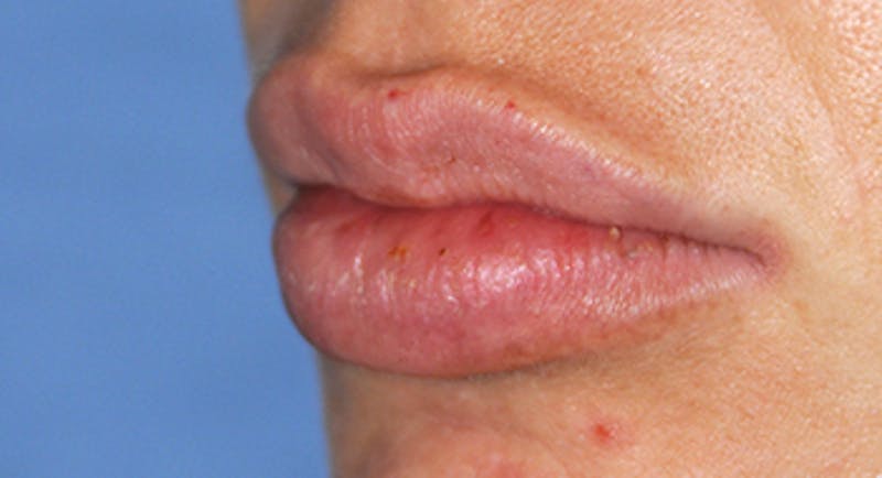 Lip Augmentation Before & After Gallery - Patient 205200 - Image 4