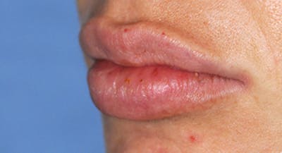 Fat Transfer Before & After Gallery - Patient 287822 - Image 2