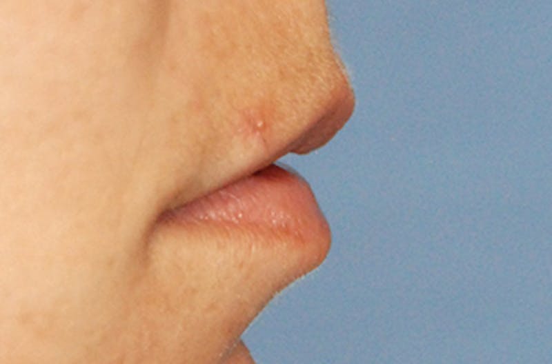 Lip Augmentation Before & After Gallery - Patient 377272 - Image 1