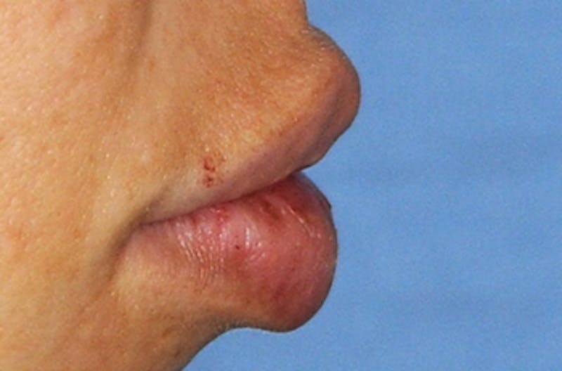 Lip Augmentation Before & After Gallery - Patient 377272 - Image 2
