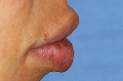Lip Augmentation Before & After Gallery - Patient 377272 - Image 2
