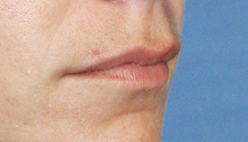 Lip Augmentation Before & After Gallery - Patient 377272 - Image 3