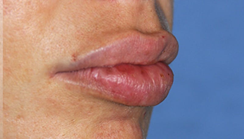 Lip Augmentation Before & After Gallery - Patient 377272 - Image 4