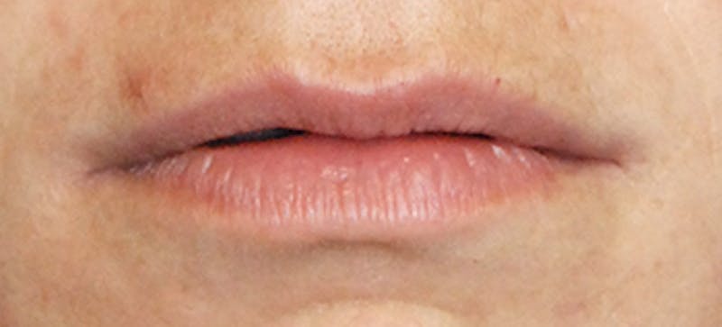 Lip Augmentation Before & After Gallery - Patient 377272 - Image 5
