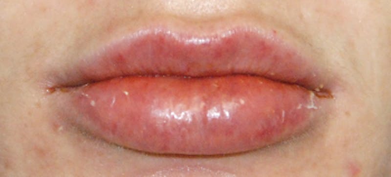 Lip Augmentation Before & After Gallery - Patient 377272 - Image 6