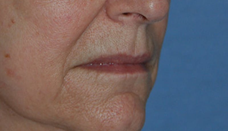 Fat Transfer Before & After Gallery - Patient 916051 - Image 1