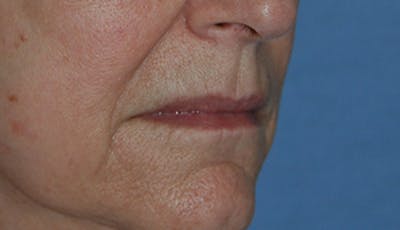 Lip Augmentation Before & After Gallery - Patient 249719 - Image 1