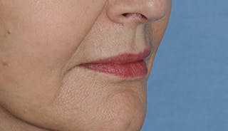 Fat Transfer Before & After Gallery - Patient 916051 - Image 2