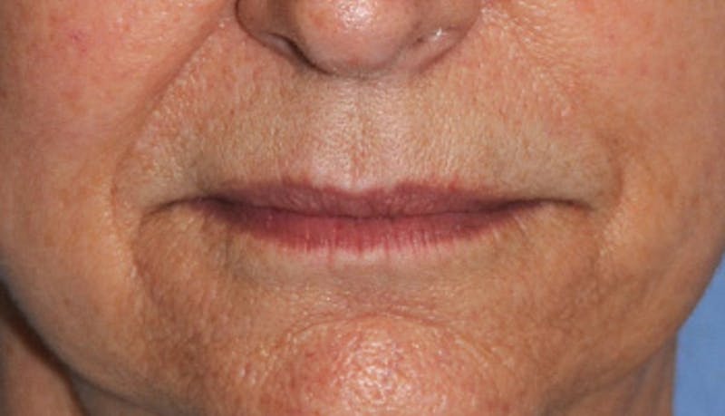 Fat Transfer Before & After Gallery - Patient 916051 - Image 3
