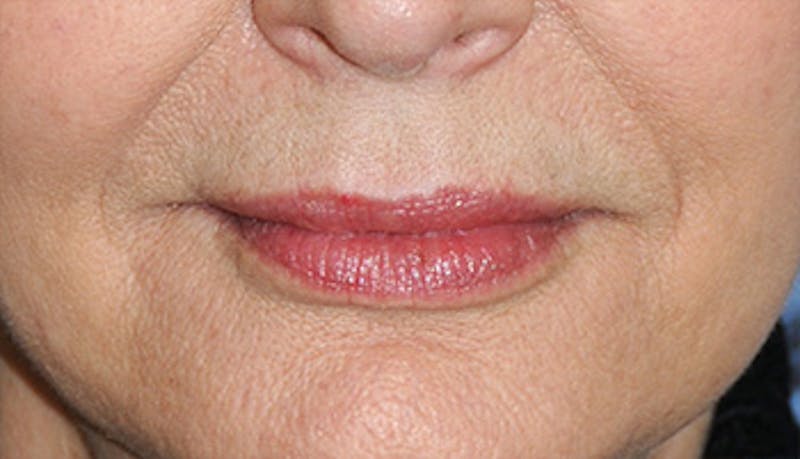 Fat Transfer Before & After Gallery - Patient 916051 - Image 4