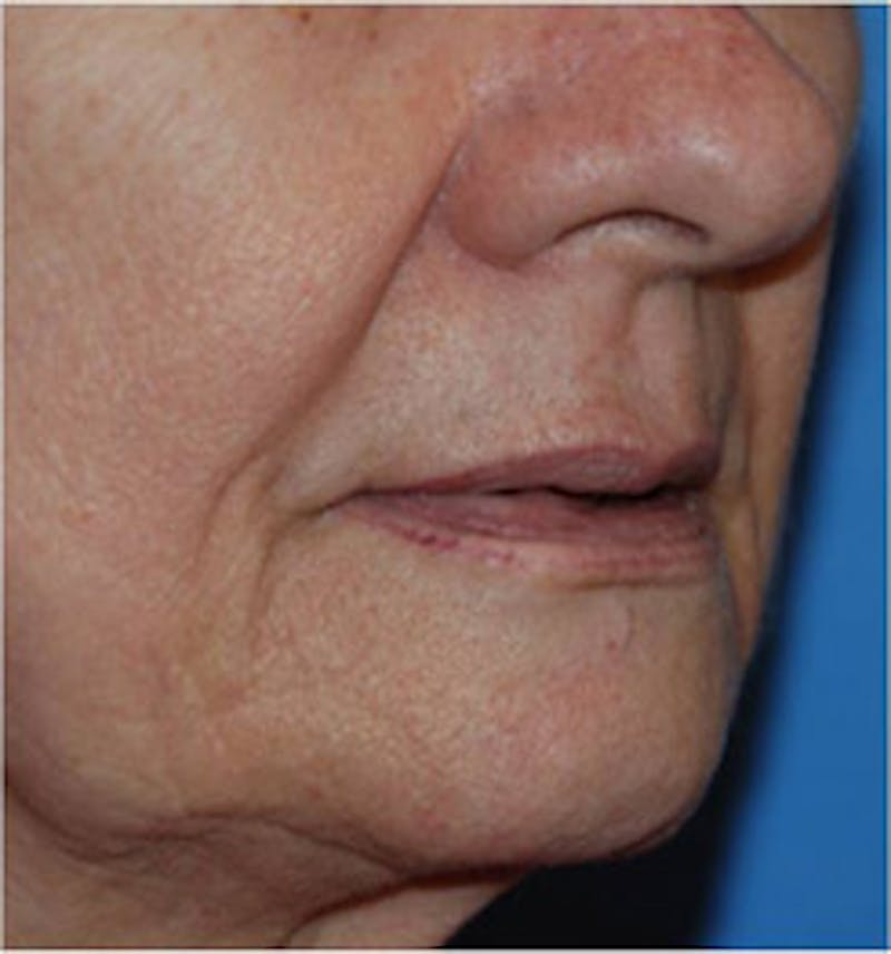 Lip Augmentation Before & After Gallery - Patient 111390 - Image 1