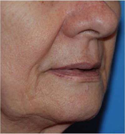 Lip Augmentation Before & After Gallery - Patient 111390 - Image 1