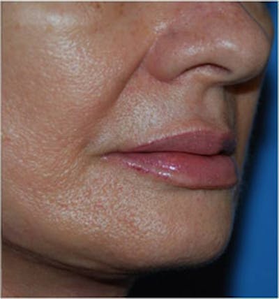 Lip Augmentation Before & After Gallery - Patient 111390 - Image 2