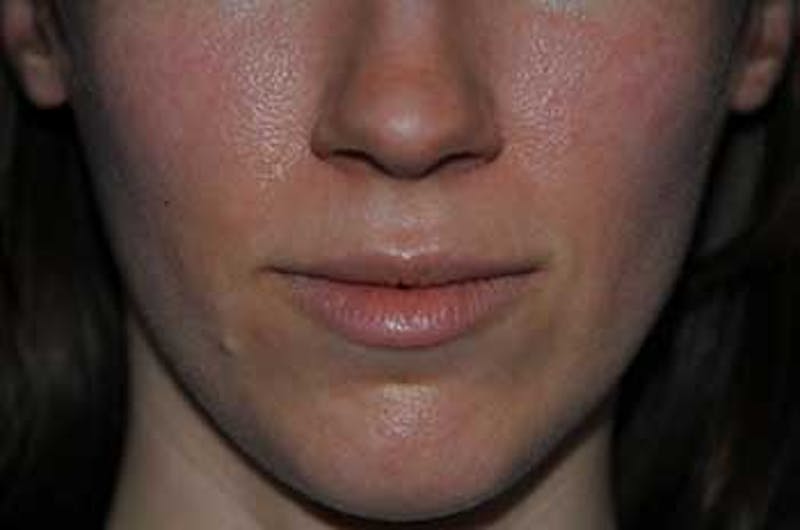 Fat Transfer Before & After Gallery - Patient 301857 - Image 1