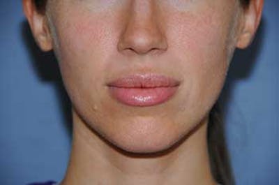 Fat Transfer Before & After Gallery - Patient 301857 - Image 2
