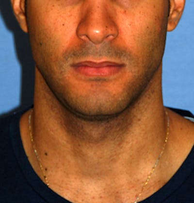 Jaw Implants Before & After Gallery - Patient 152269 - Image 1